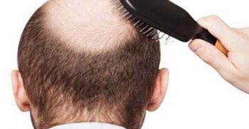 চুল পড়া বন্ধে পেঁয়াজের রসের নানাবিধ ব্যবহার