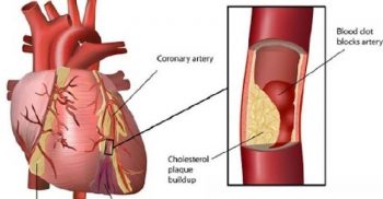 ২৮ প্রকারের হার্টের রিংয়ের দাম কমছে!
