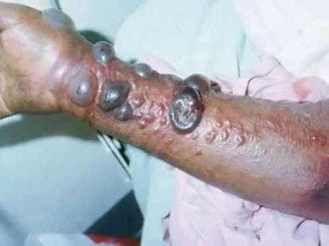 আবারও ইবোলা আতঙ্ক! সাবধান থাকুন সবাই