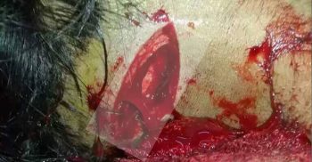 ফেনীর ছাগলনাইয়ায় স্কুল ছাত্রীর ঘাড়ে কুপিয়ে জখম করেছে ডাকাত