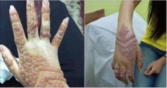 মেহেদী থেকে ছড়াচ্ছে ভয়ঙ্কর রোগ