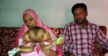পাবনায় জন্ম নিলো জোড়া মাথার যমজ শিশু