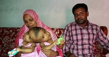পাবনায় জন্ম নিলো জোড়া মাথার যমজ শিশু