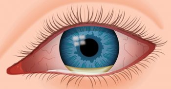 শারীরিক সমস্যার প্রথম লক্ষণ প্রকাশ পায় চোখে