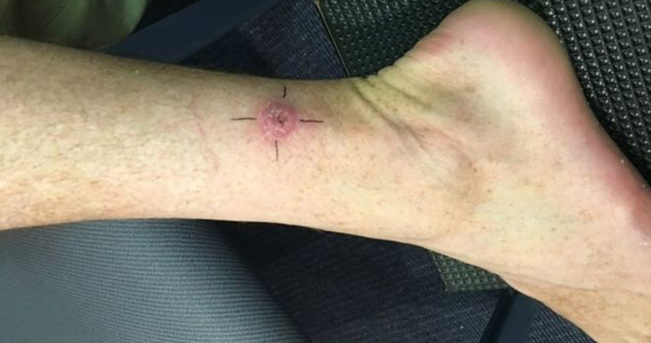 মাংসখেকো ফোঁড়া নিয়ে দুশ্চিন্তায় অস্ট্রেলিয়ার ডাক্তাররা