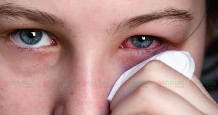 আপনার চোখ কি লাল হয়ে যায় সবসময়?