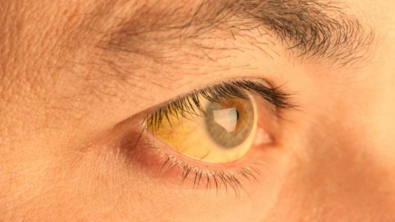 জন্ডিস নিয়ে আমাদের যত ভুল ধারণা