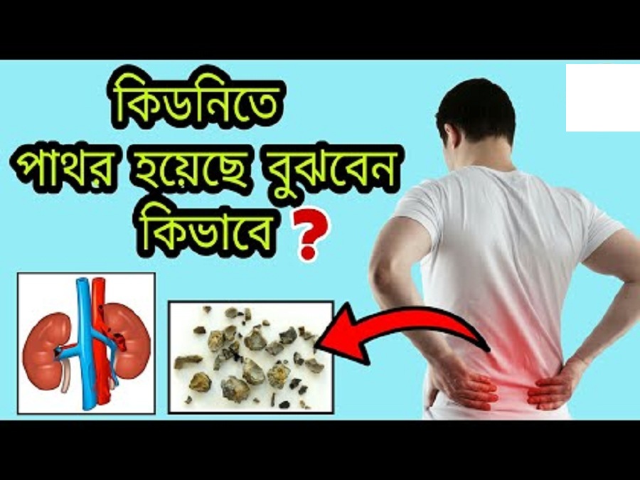 কিডনিতে পাথর জমছে! কিভাবে বুঝবেন?